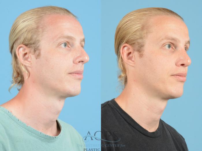 Before & After Septoplasty with Rhinoplasty Case 1371 Oblique View: View in Houston, TX