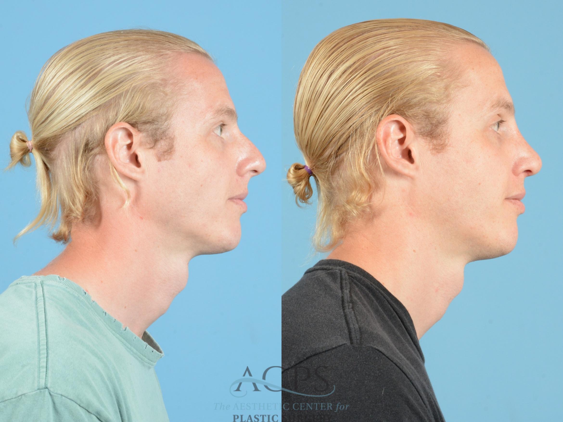 Before & After Septoplasty with Rhinoplasty Case 1371 Side View: View in Houston, TX