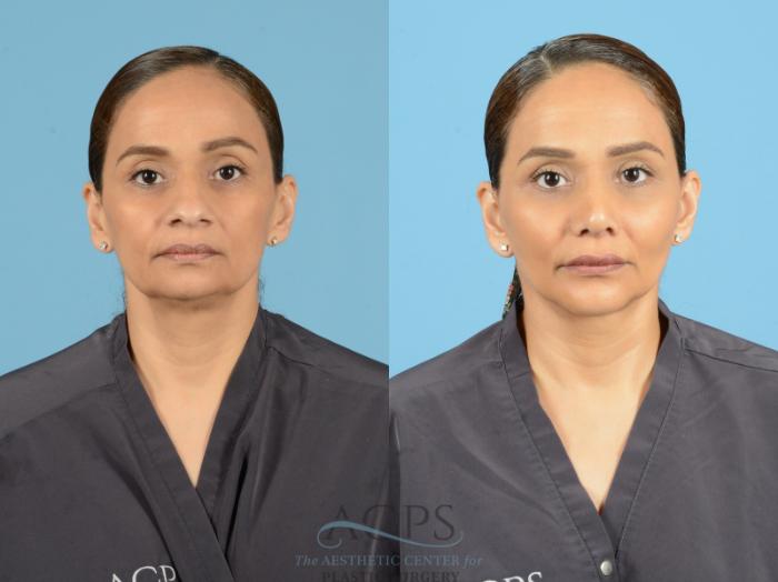 Before & After Septoplasty with Rhinoplasty Case 1372 Front View: View in Houston, TX