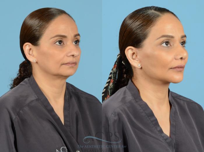 Before & After Septoplasty with Rhinoplasty Case 1372 Oblique View: View in Houston, TX