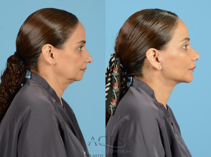 Before & After Septoplasty with Rhinoplasty Case 1372 Side View: View in Houston, TX