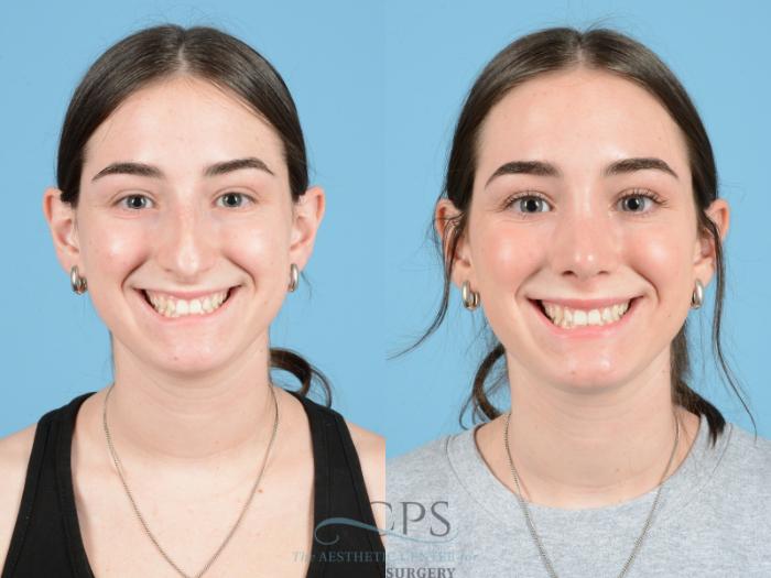 Before & After Septoplasty with Rhinoplasty Case 1373 Front View: View in Houston, TX