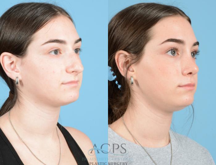 Before & After Septoplasty with Rhinoplasty Case 1373 Oblique View: View in Houston, TX