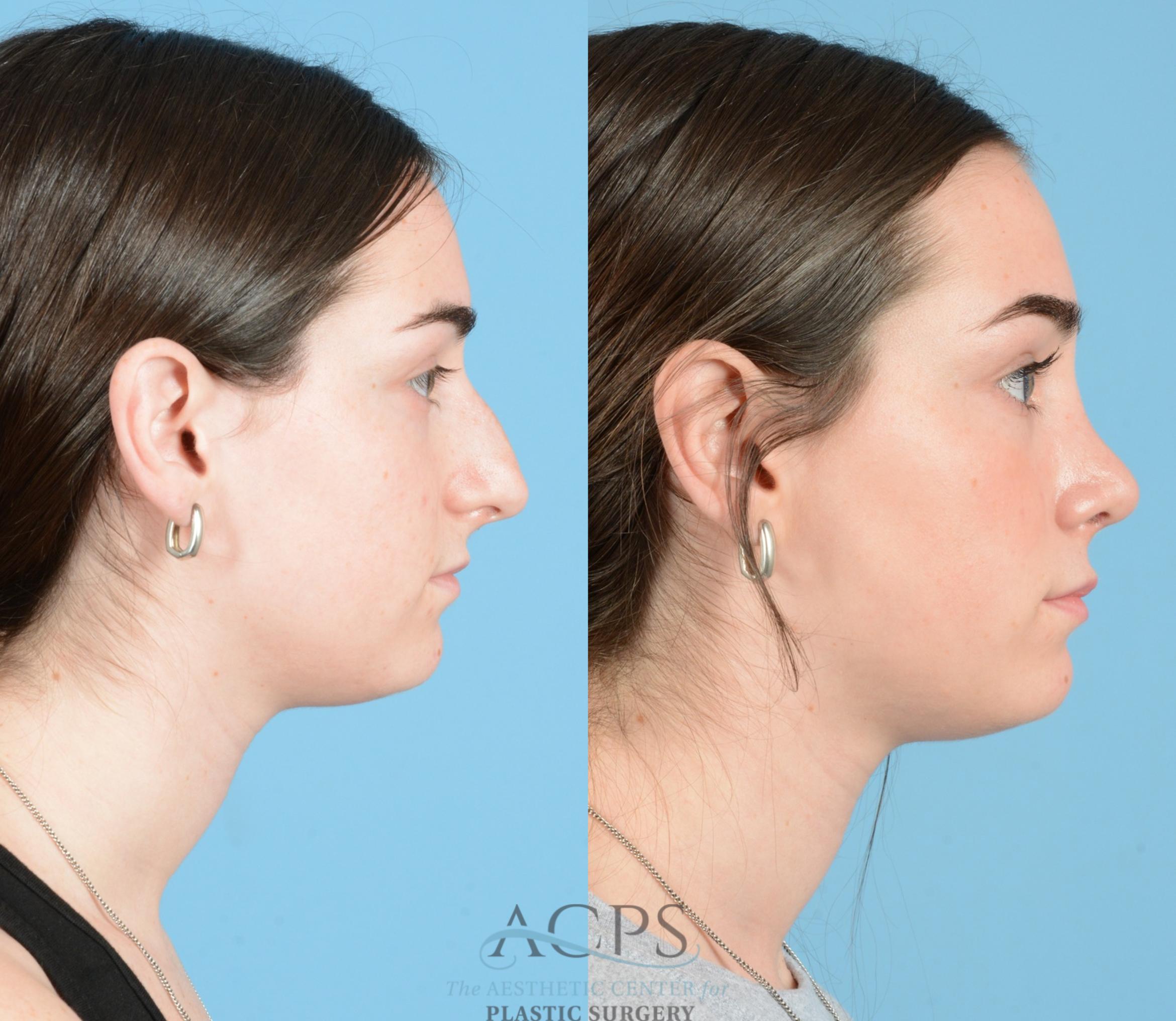 Before & After Septoplasty with Rhinoplasty Case 1373 Side View: View in Houston, TX
