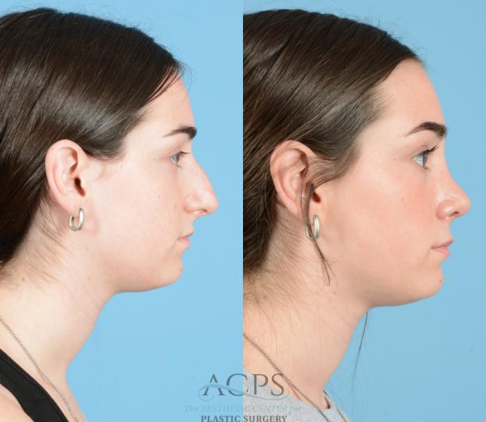 Before & After Septoplasty with Rhinoplasty Case 1373 Side View: View in Houston, TX