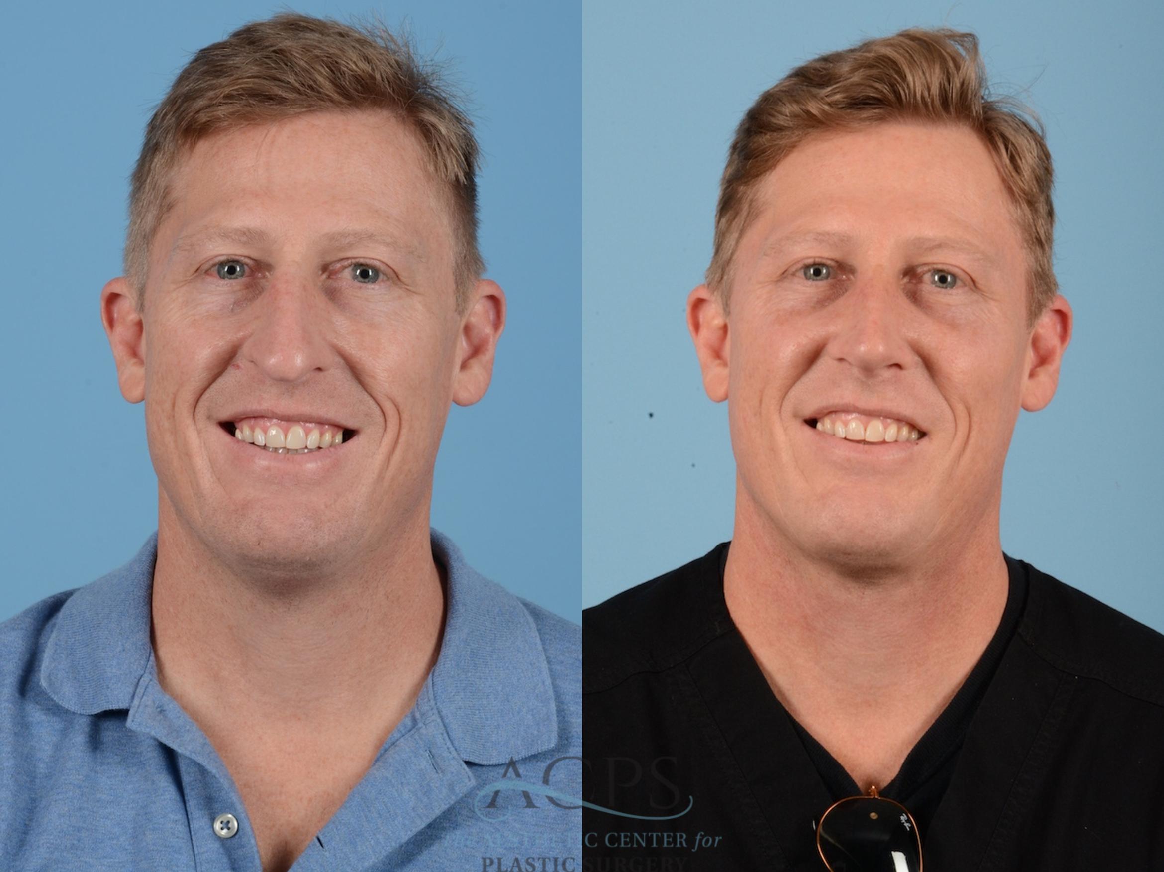 Before & After Septoplasty with Rhinoplasty Case 1374 Front View: View in Houston, TX