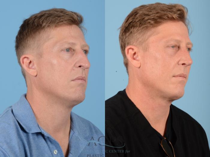 Before & After Septoplasty with Rhinoplasty Case 1374 Oblique View: View in Houston, TX