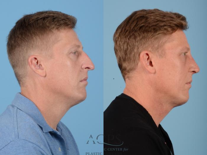 Before & After Septoplasty with Rhinoplasty Case 1374 Side View: View in Houston, TX