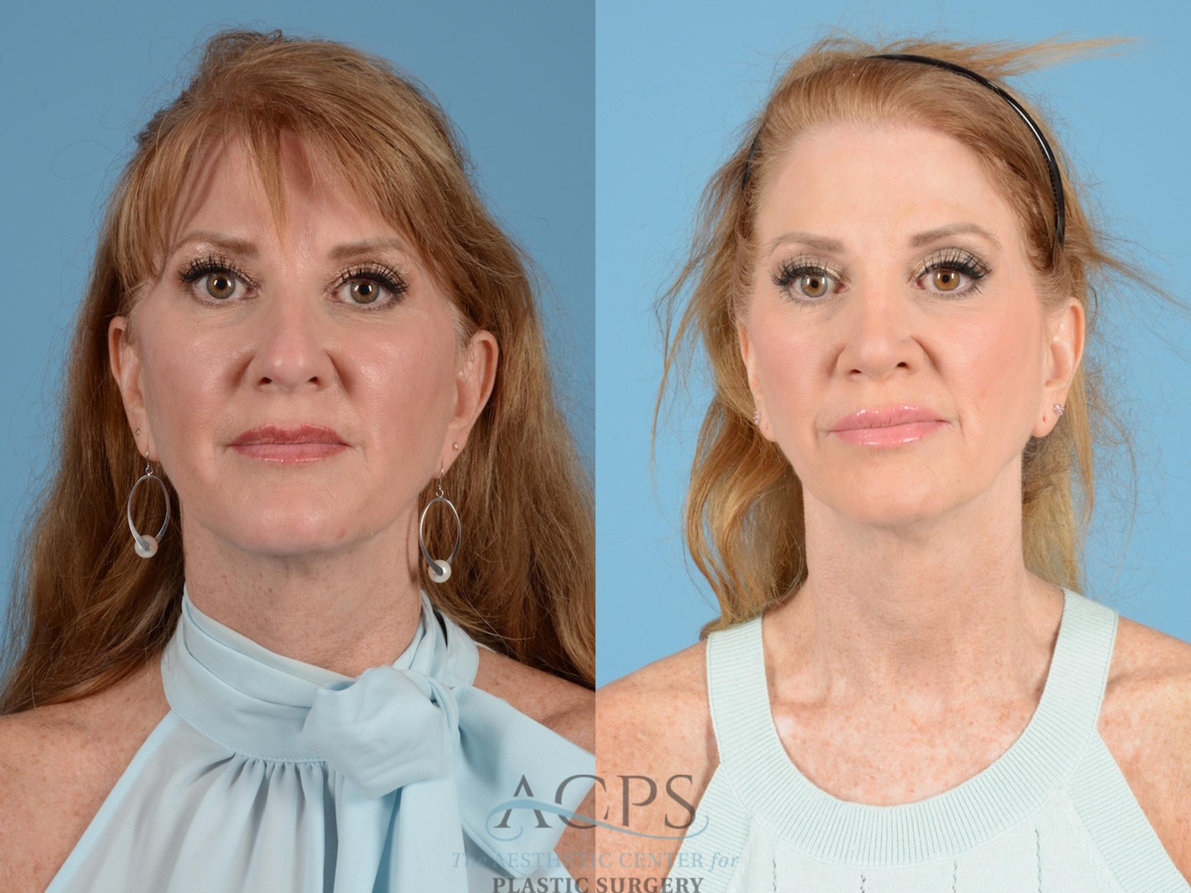 Before & After Septoplasty with Rhinoplasty Case 1375 Front View: View in Houston, TX