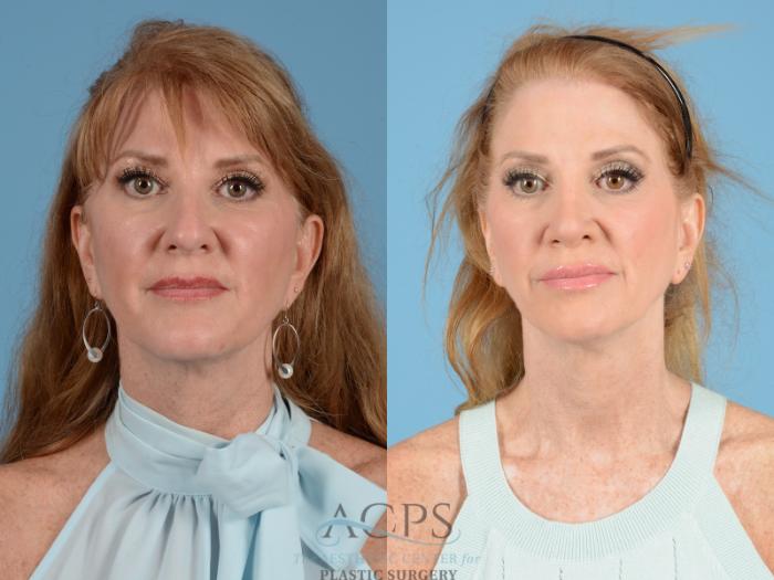 Before & After Septoplasty with Rhinoplasty Case 1375 Front View: View in Houston, TX