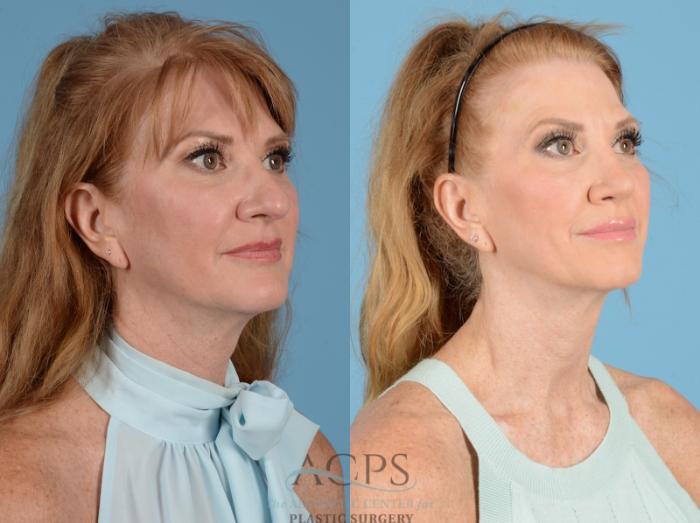 Before & After Septoplasty with Rhinoplasty Case 1375 Oblique View: View in Houston, TX