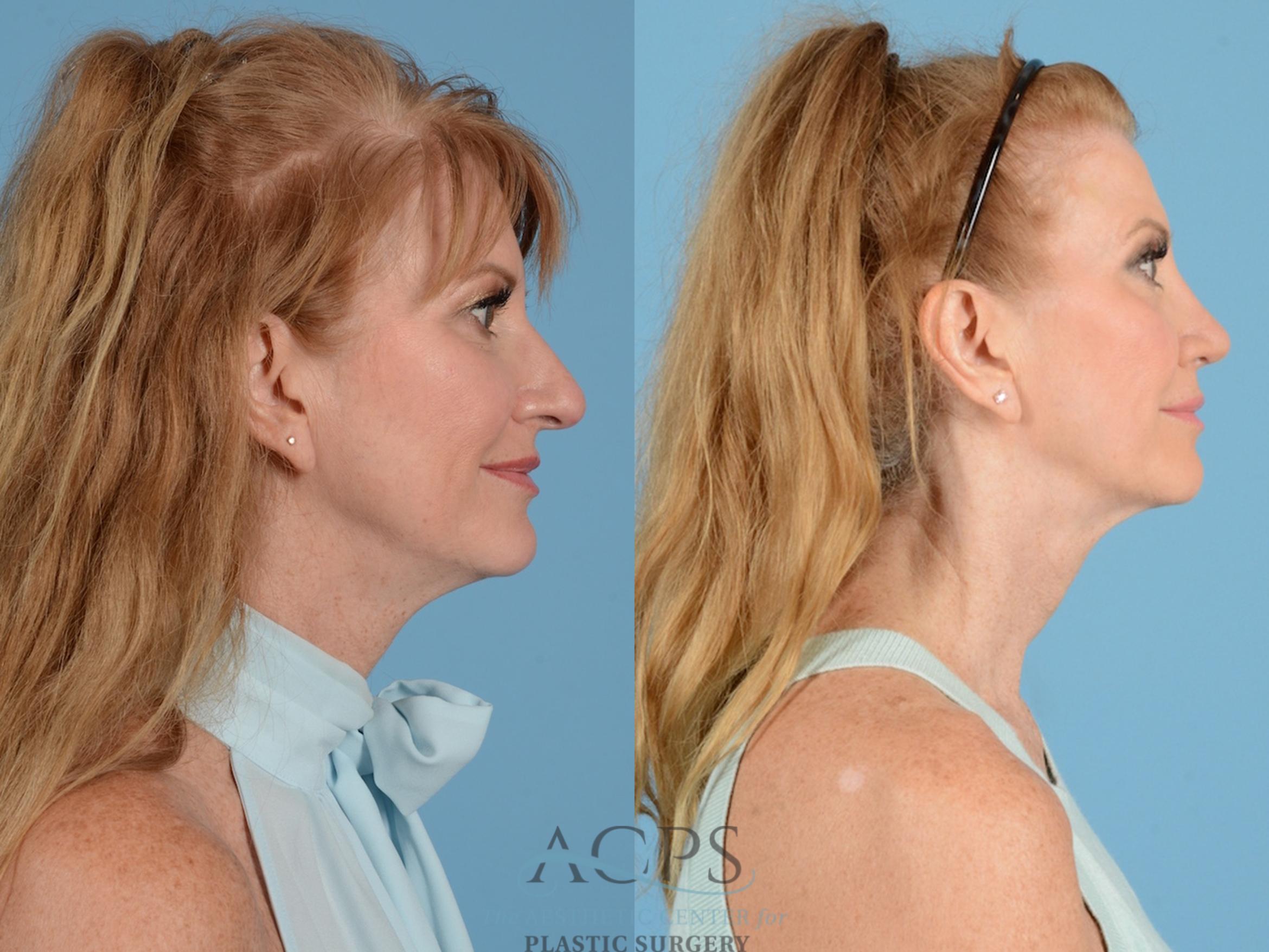 Before & After Septoplasty with Rhinoplasty Case 1375 Side View: View in Houston, TX