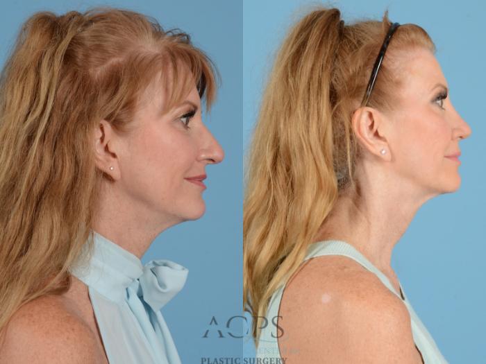 Before & After Septoplasty with Rhinoplasty Case 1375 Side View: View in Houston, TX