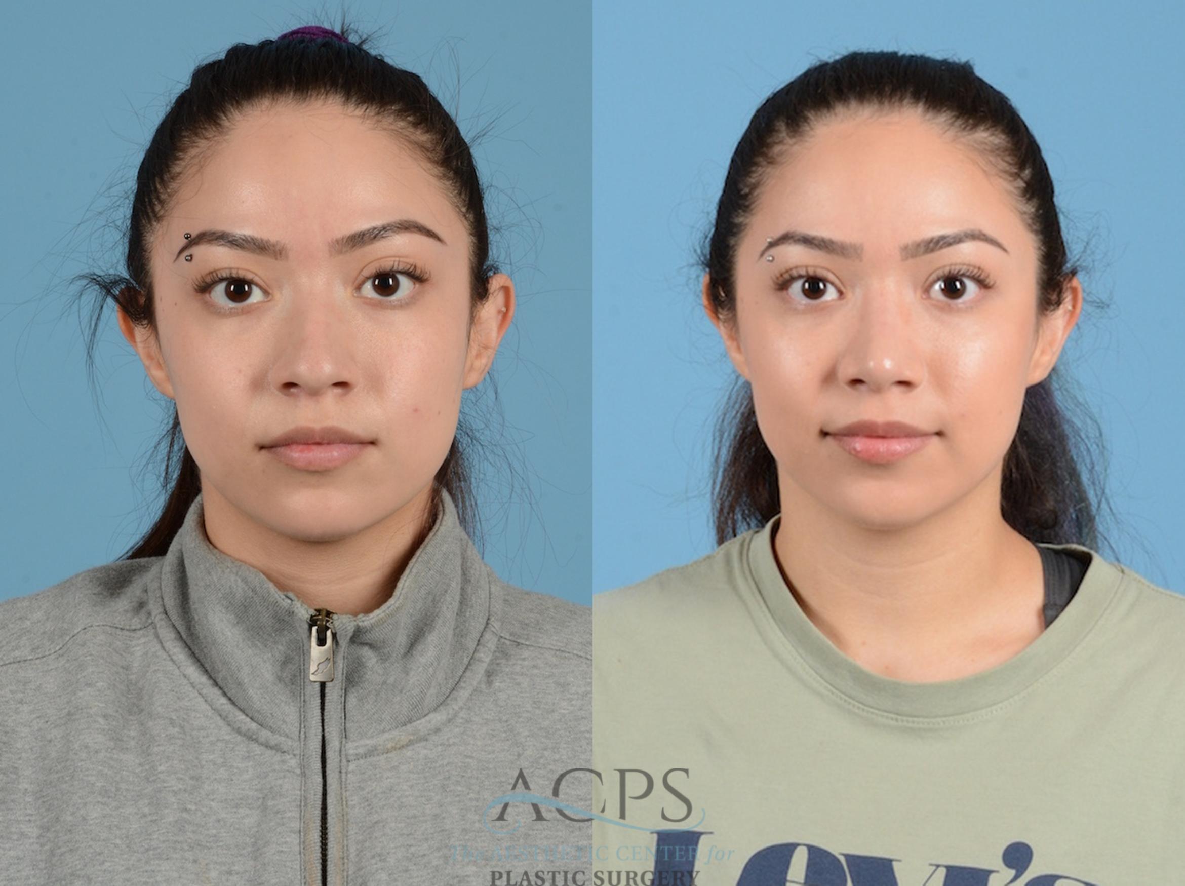 Before & After Septoplasty with Rhinoplasty Case 1376 Front View: View in Houston, TX