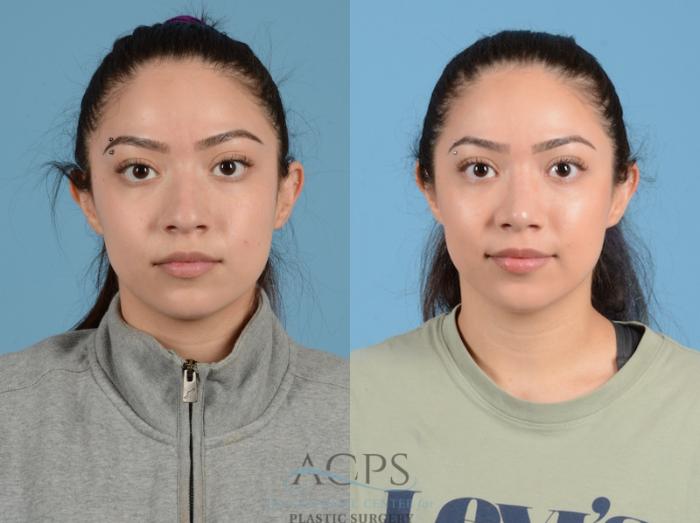 Before & After Septoplasty with Rhinoplasty Case 1376 Front View: View in Houston, TX