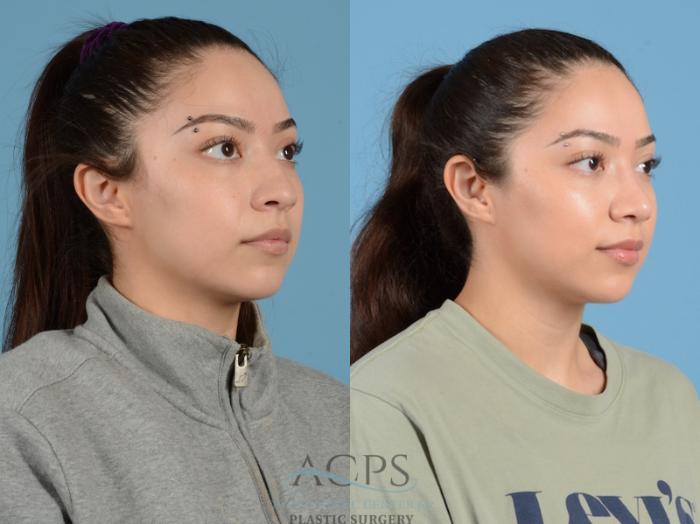 Before & After Septoplasty with Rhinoplasty Case 1376 Oblique View: View in Houston, TX