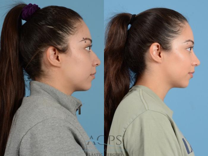 Before & After Septoplasty with Rhinoplasty Case 1376 Side View: View in Houston, TX
