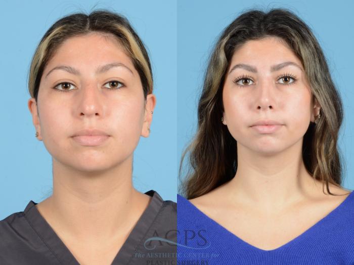 Before & After Septoplasty with Rhinoplasty Case 1377 Front View: View in Houston, TX