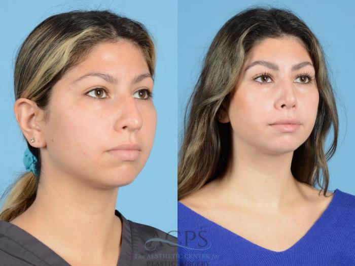 Before & After Septoplasty with Rhinoplasty Case 1377 Oblique View: View in Houston, TX