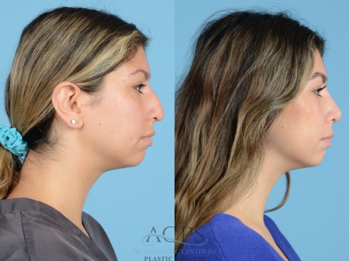 Before & After Septoplasty with Rhinoplasty Case 1377 Side View: View in Houston, TX