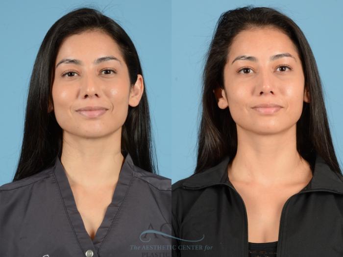 Before & After Septoplasty with Rhinoplasty Case 1378 Front View: View in Houston, TX