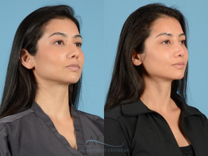 Before & After Septoplasty with Rhinoplasty Case 1378 Oblique View: View in Houston, TX
