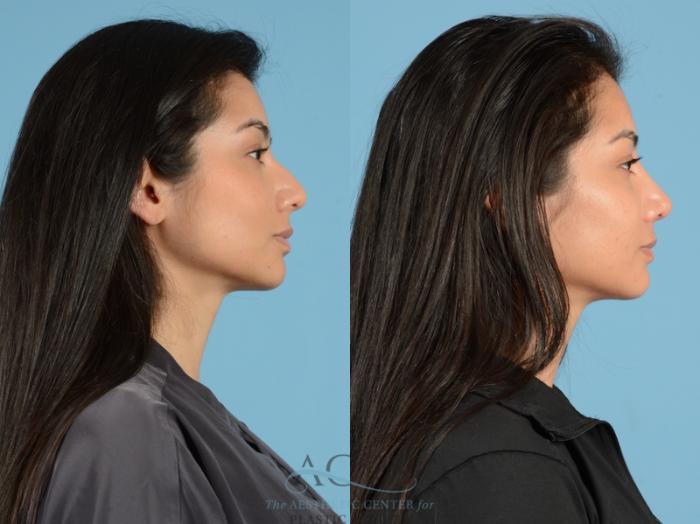 Before & After Septoplasty with Rhinoplasty Case 1378 Side View: View in Houston, TX