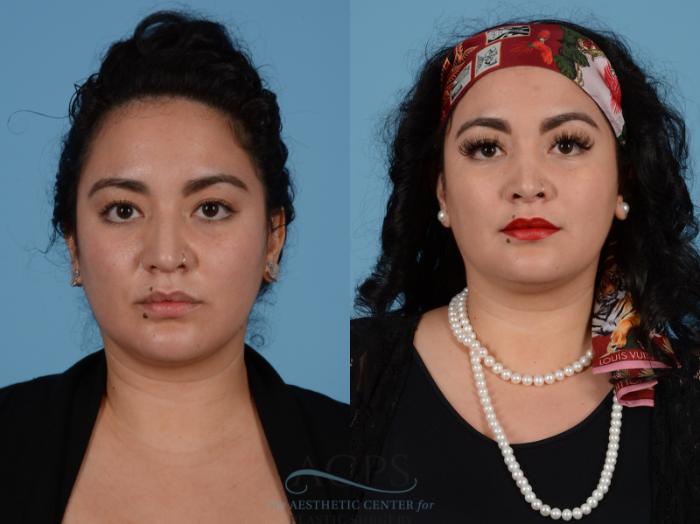 Before & After Septoplasty with Rhinoplasty Case 1379 Front View: View in Houston, TX