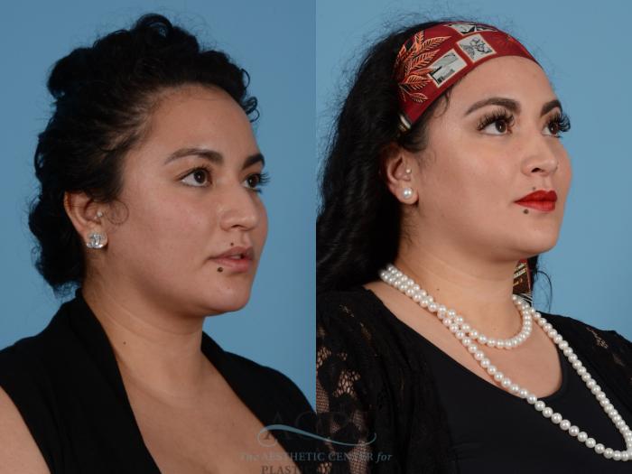 Before & After Septoplasty with Rhinoplasty Case 1379 Oblique View: View in Houston, TX