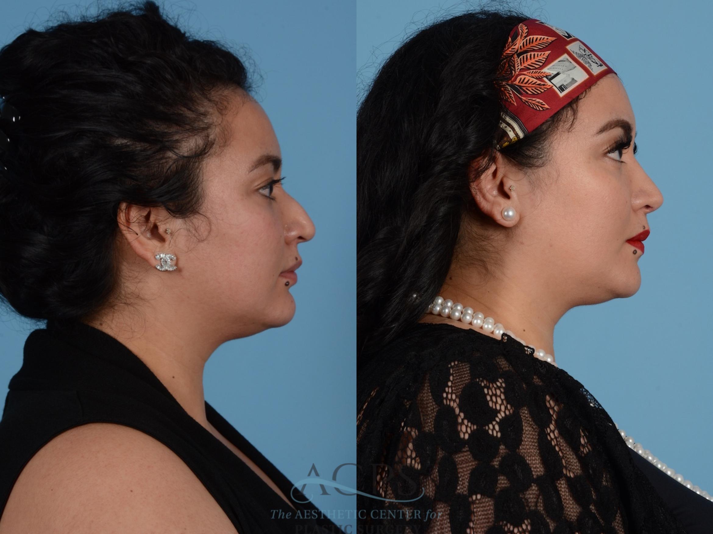 Before & After Septoplasty with Rhinoplasty Case 1379 Side View: View in Houston, TX