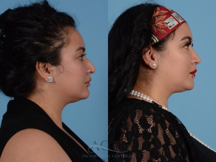 Before & After Septoplasty with Rhinoplasty Case 1379 Side View: View in Houston, TX