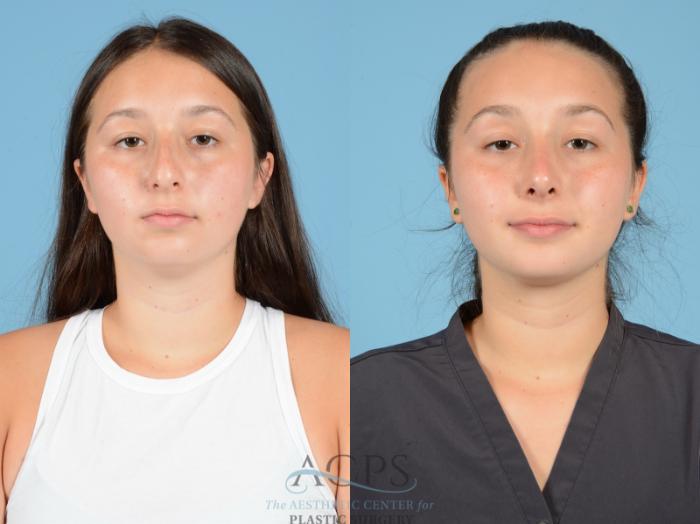 Before & After Septoplasty with Rhinoplasty Case 1380 Front View: View in Houston, TX