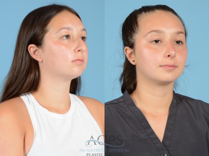Before & After Septoplasty with Rhinoplasty Case 1380 Oblique View: View in Houston, TX