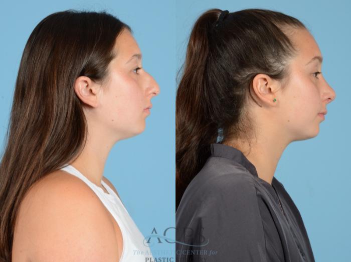 Before & After Septoplasty with Rhinoplasty Case 1380 Side View: View in Houston, TX