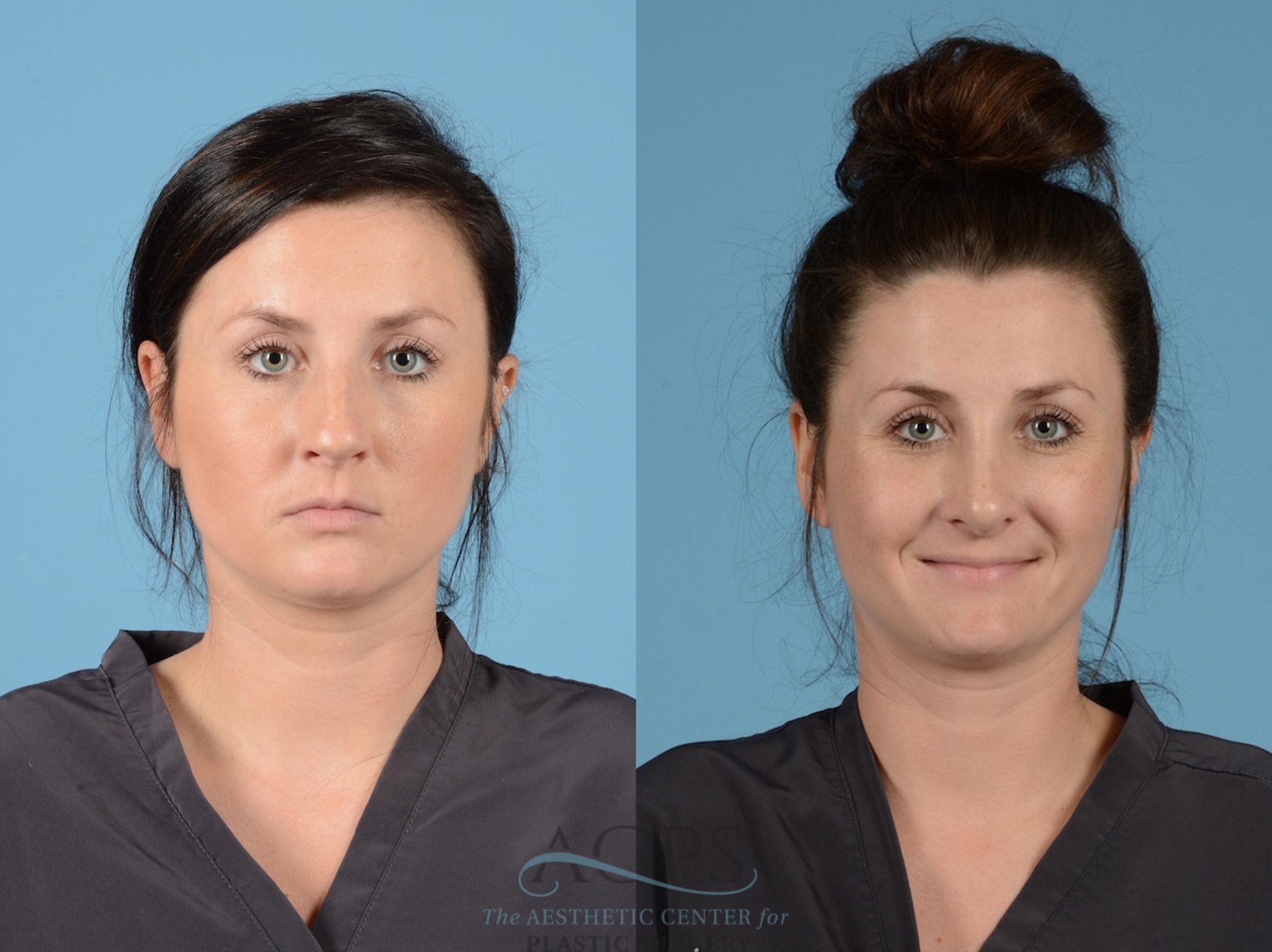Before & After Septoplasty with Rhinoplasty Case 1381 Front View: View in Houston, TX
