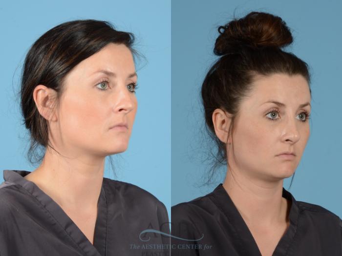 Before & After Septoplasty with Rhinoplasty Case 1381 Oblique View: View in Houston, TX