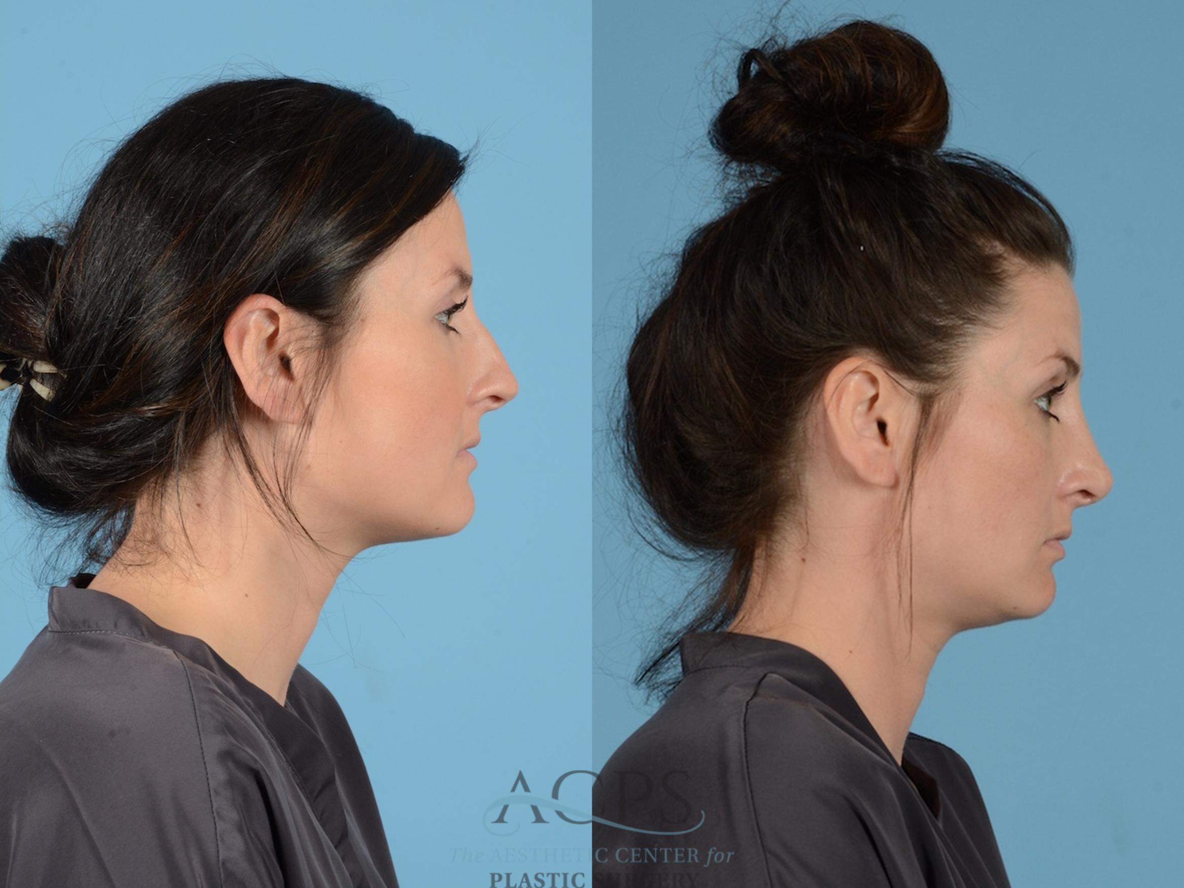 Before & After Septoplasty with Rhinoplasty Case 1381 Side View: View in Houston, TX