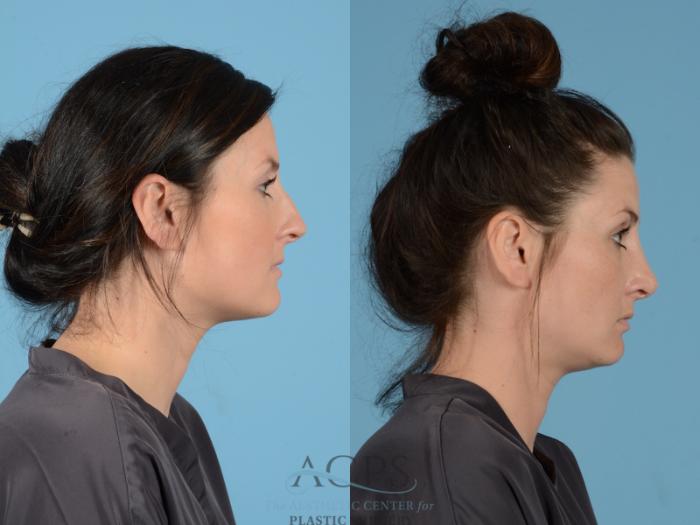 Before & After Septoplasty with Rhinoplasty Case 1381 Side View: View in Houston, TX