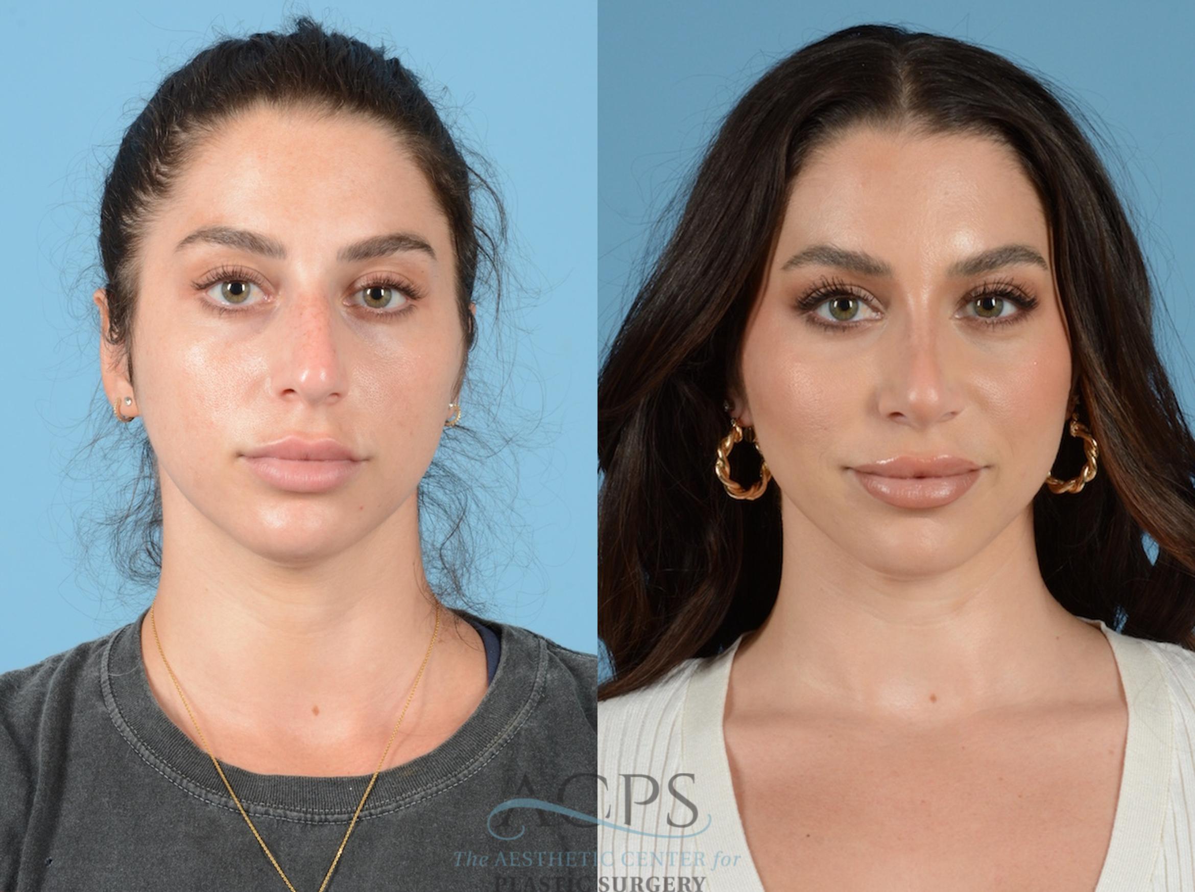 Before & After Septoplasty with Rhinoplasty Case 1382 Front View: View in Houston, TX