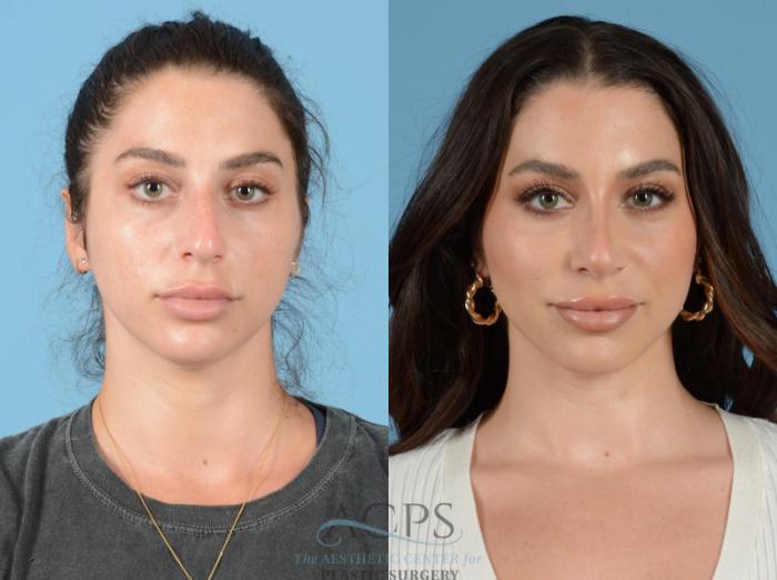 Before & After Septoplasty with Rhinoplasty Case 1382 Front View: View in Houston, TX