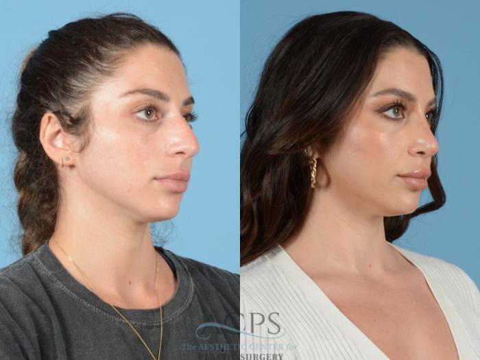 Before & After Septoplasty with Rhinoplasty Case 1382 Oblique View: View in Houston, TX