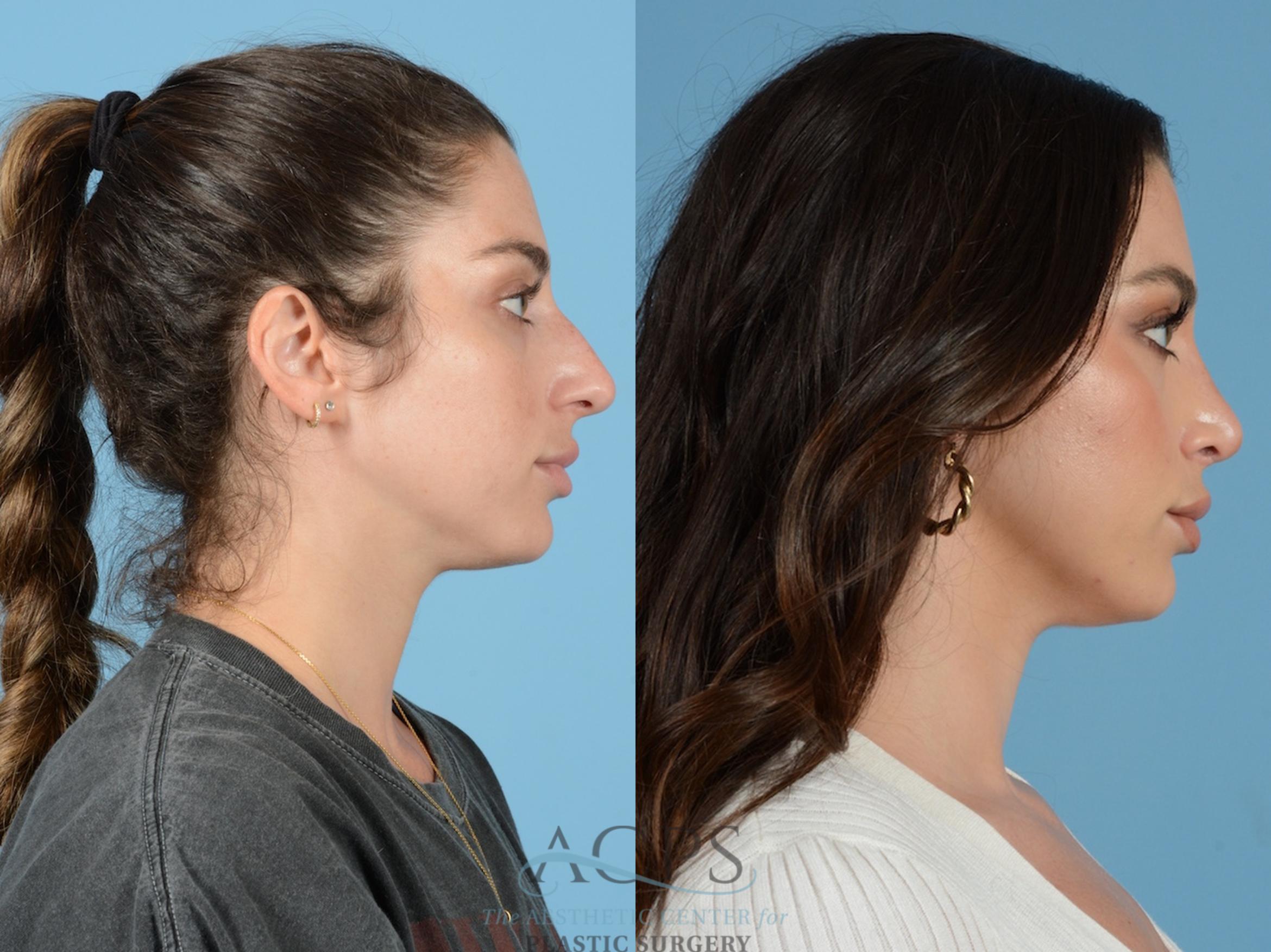 Before & After Septoplasty with Rhinoplasty Case 1382 Side View: View in Houston, TX