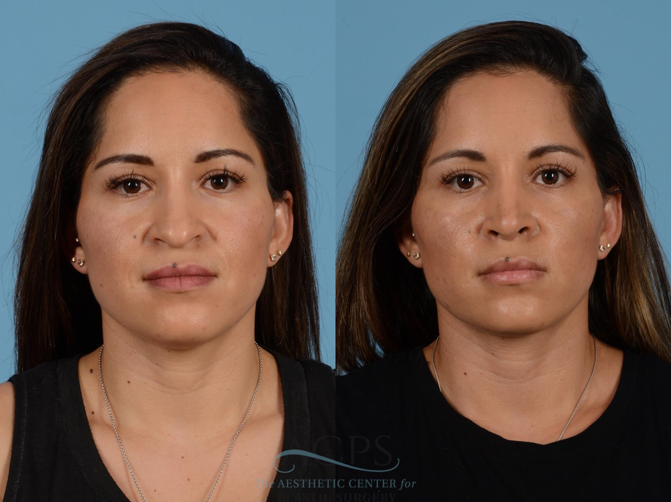 Before & After Septoplasty with Rhinoplasty Case 1383 Front View: View in Houston, TX