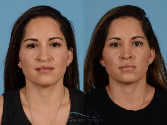 Before & After Septoplasty with Rhinoplasty Case 1383 Front View: View in Houston, TX