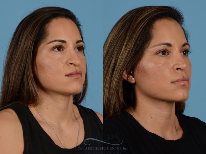 Before & After Septoplasty with Rhinoplasty Case 1383 Oblique View: View in Houston, TX