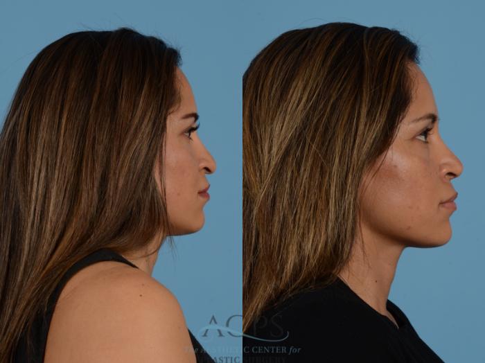 Before & After Septoplasty with Rhinoplasty Case 1383 Side View: View in Houston, TX