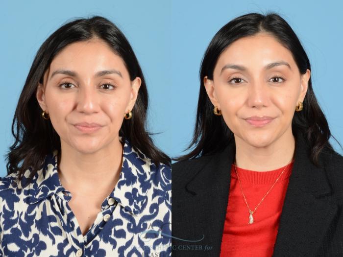 Before & After Septoplasty with Rhinoplasty Case 1384 Front View: View in Houston, TX