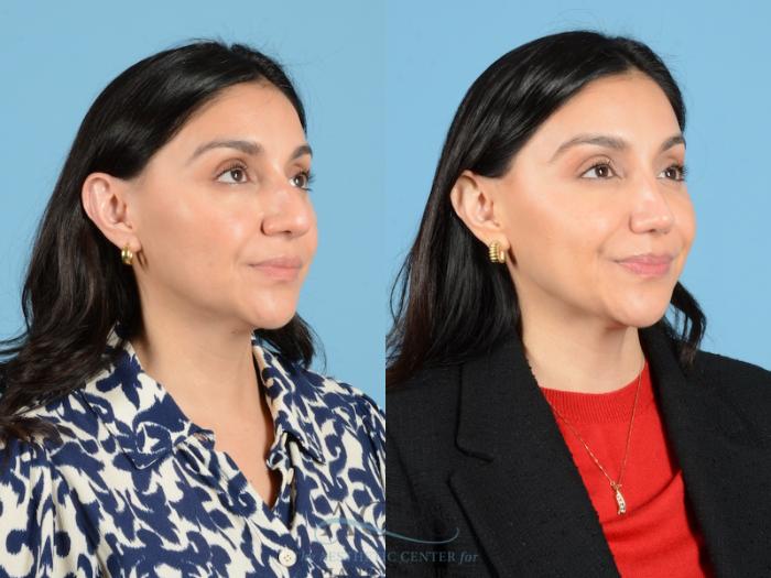 Before & After Septoplasty with Rhinoplasty Case 1384 Oblique View: View in Houston, TX