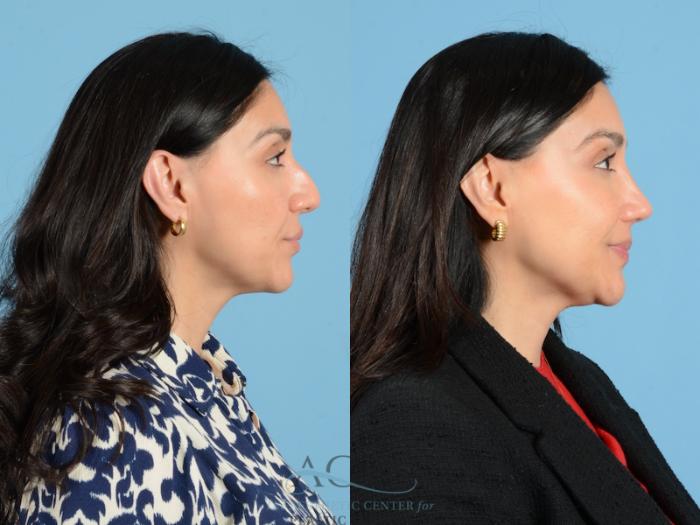 Before & After Septoplasty with Rhinoplasty Case 1384 Side View: View in Houston, TX