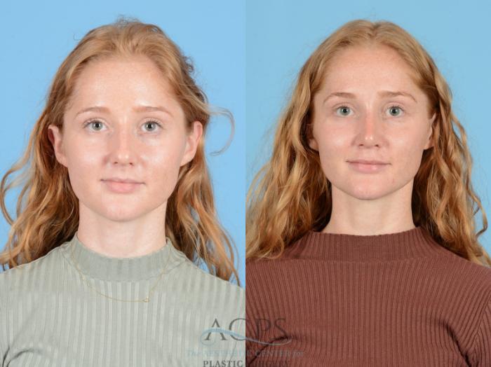 Before & After Septoplasty with Rhinoplasty Case 1385 Front View: View in Houston, TX